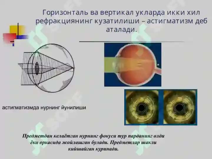 Клиник рефракция. Рефракция аномалияларини диагностикаси 7