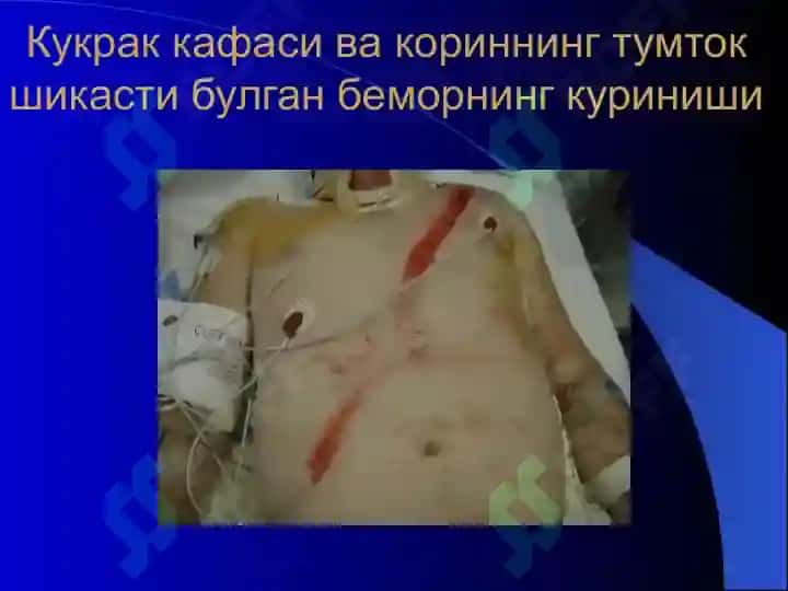 Qorin bo'shlig'i va qorin orti a'zolarining yopiq shikastlanishlari 6