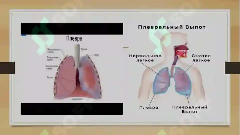 Plevra boshligida suyuqlik yigilish sindromi, plevra boshligida havo yigilish sindromi, opkada boshl 3