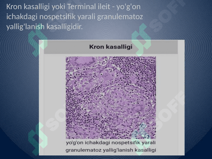 Kron kasalligi 2