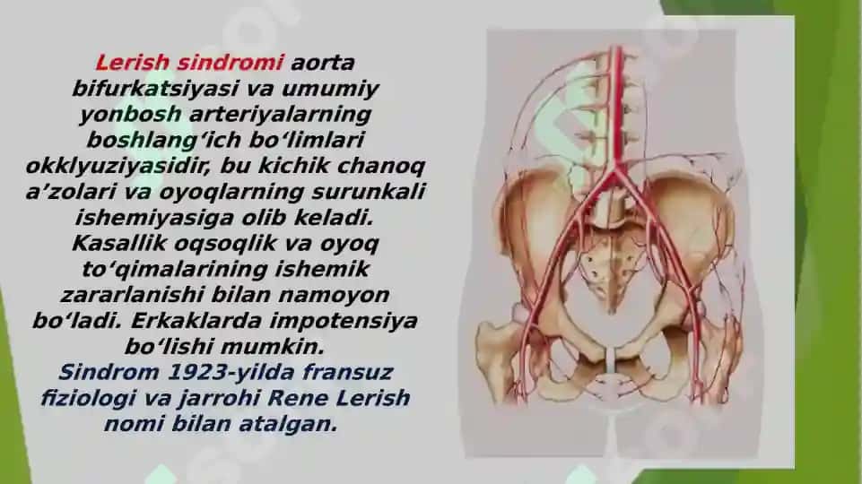 Lerish sindromi 2