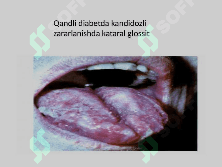 Endokarin kasalliklarida 
parodontdagi o'zgarishlari 6