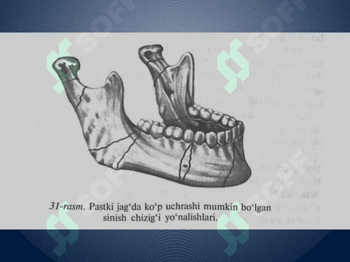 Pastki jag' sinishi 3