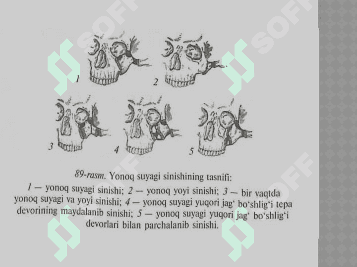 Yonoq yoyi va
 suyagini sinishi 3