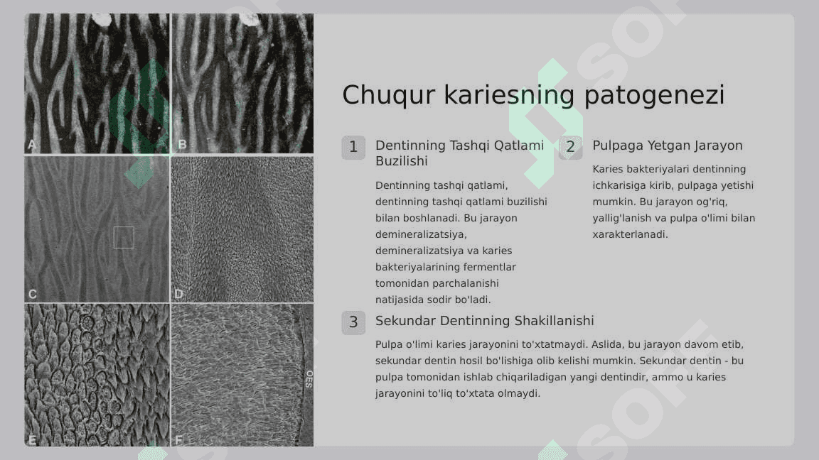 Chuqur karies.  O‘tkir va surunkali  shakllarini klinik  kechishi,  tashxislash, qiyosiy  tashxisi. Fizikaviy  tekshirish usullari  (termoelektroodonto  diagnostika). 5