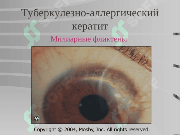 keratitlar (2) 7