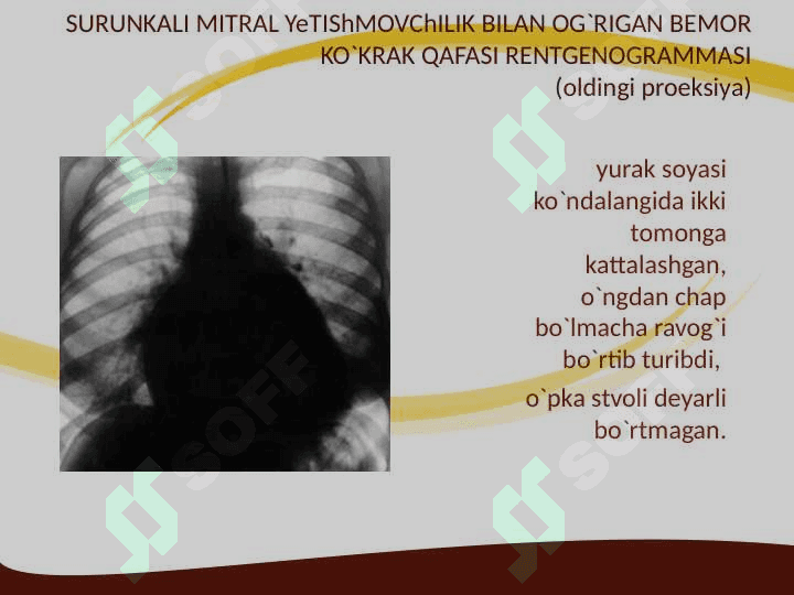 Mitral klapan prolapsi 8