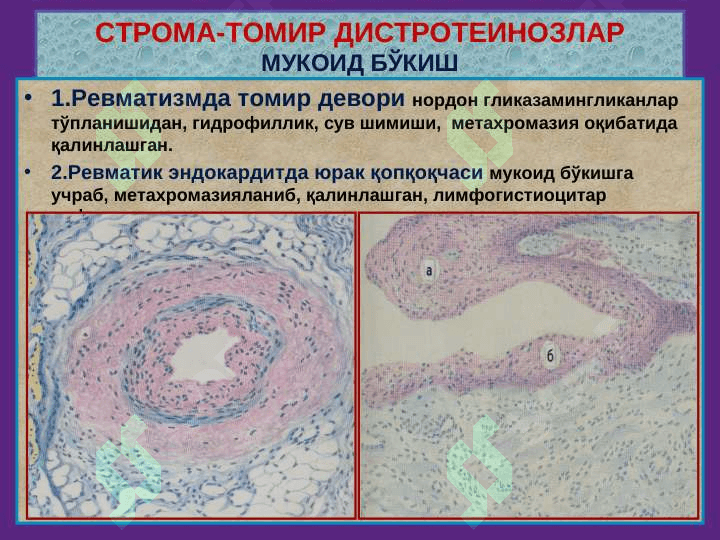 Stroma va tomir distrofiyalari . Distrofiya - distrr=ofiyalar 6
