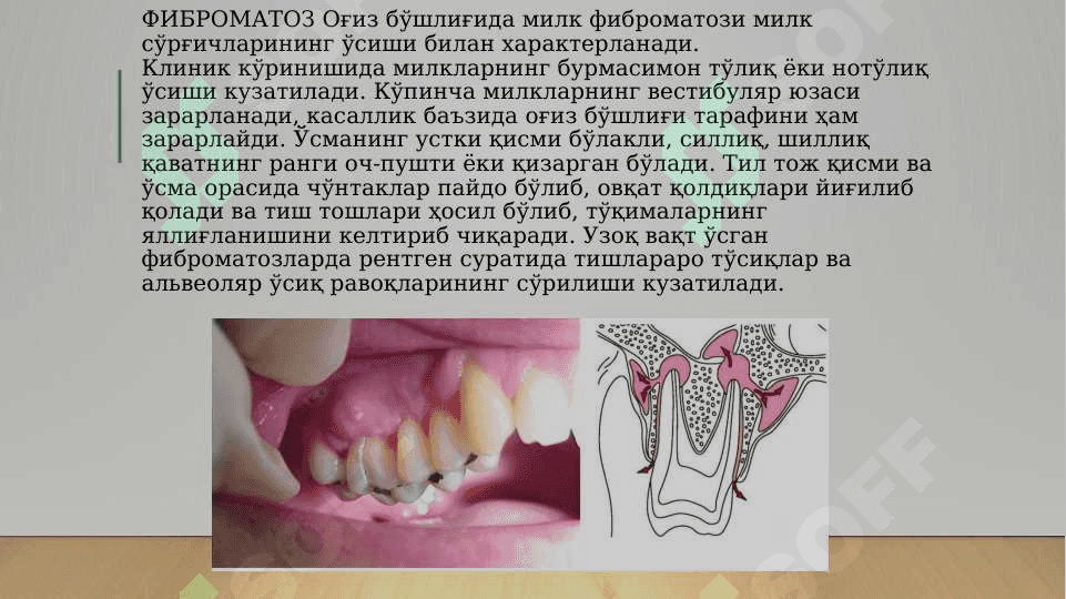 Yuz-jag‘ sohasi yumshoq to‘qimalari xavfsiz o‘smalari va o‘smasimon hosilalari 4