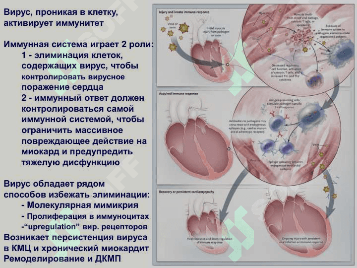 Миокардит 8