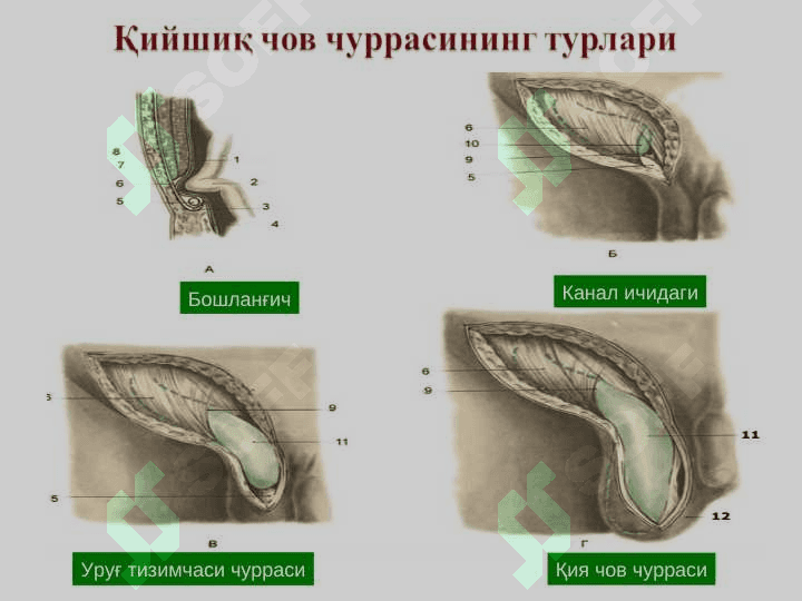 Чов, сон, киндик ва қорин оқ чизиғи чурралари 6