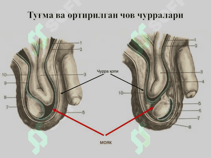 Чов, сон, киндик ва қорин оқ чизиғи чурралари 8