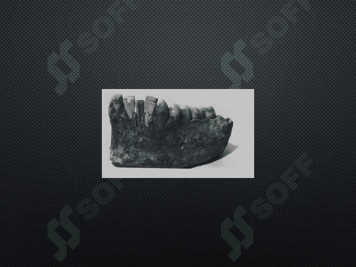 Dental
 implantatsiya tarixi 5