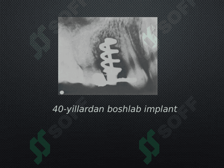 Dental
 implantatsiya tarixi 7