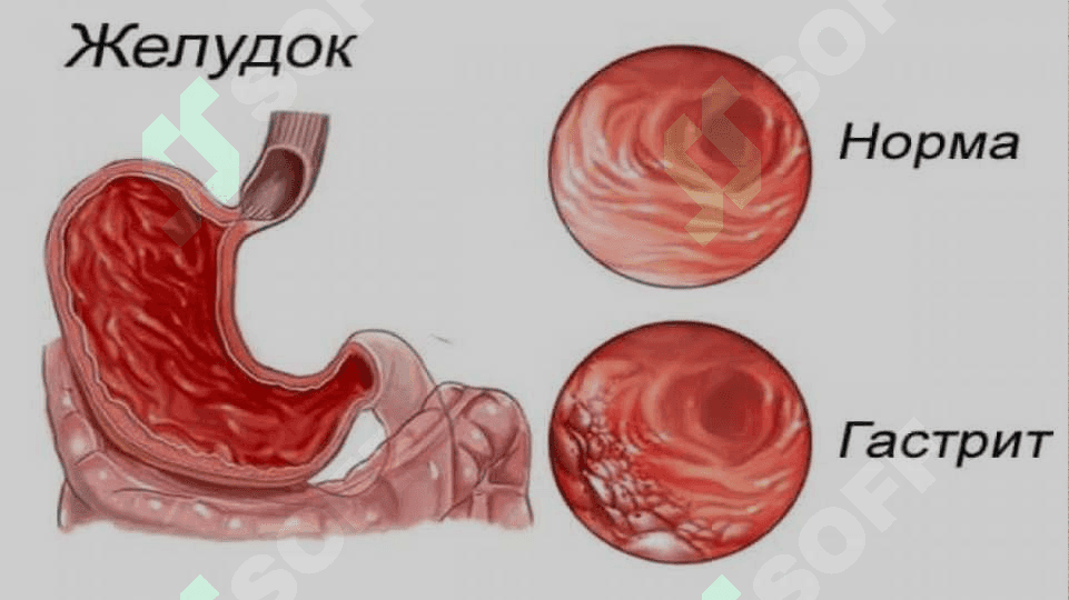 Gastirit Oshqozon ichak yarasi va kolit kelib chiqishida mikroorganizmlarning ahamiyati patogenizi labaratoriya tashxisi 4