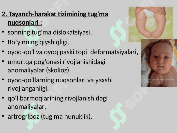 Xarakat-tayanch a’zolarida nuqsoni bo‘lgan bolalar 8