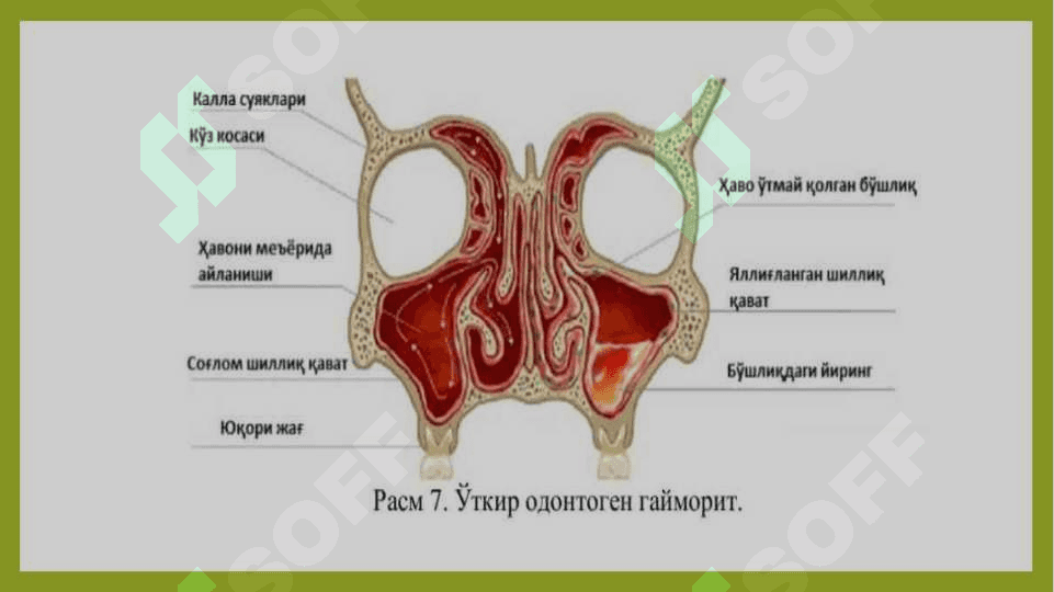 Odontogen gaymorit 3