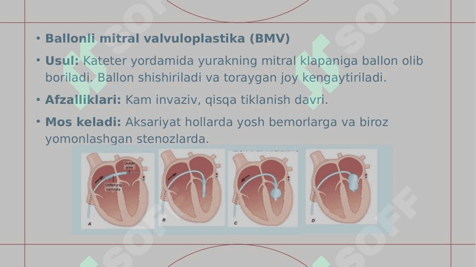 Mitral stenozda jarrohlik 2