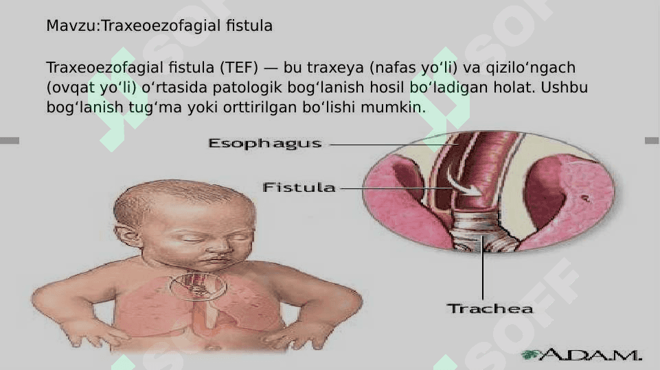 Traxeoezofagial fistula 2