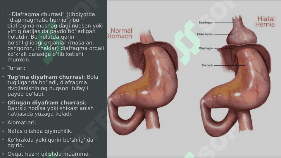 Diafragma churrasida nissen bo'yicha fundoplikatsiya amaliyoti 2