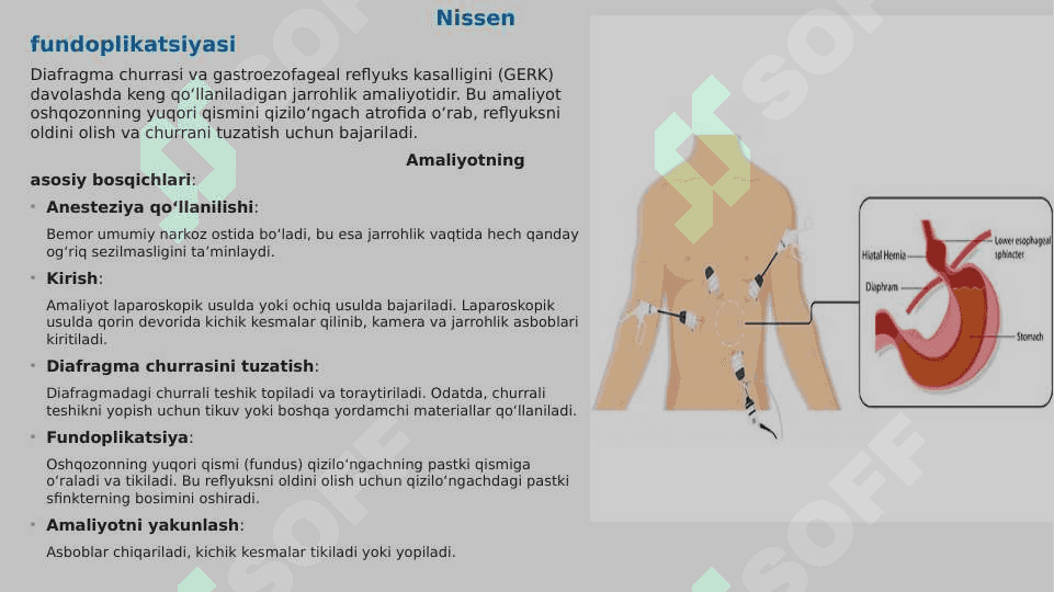 Diafragma churrasida nissen bo'yicha fundoplikatsiya amaliyoti 3