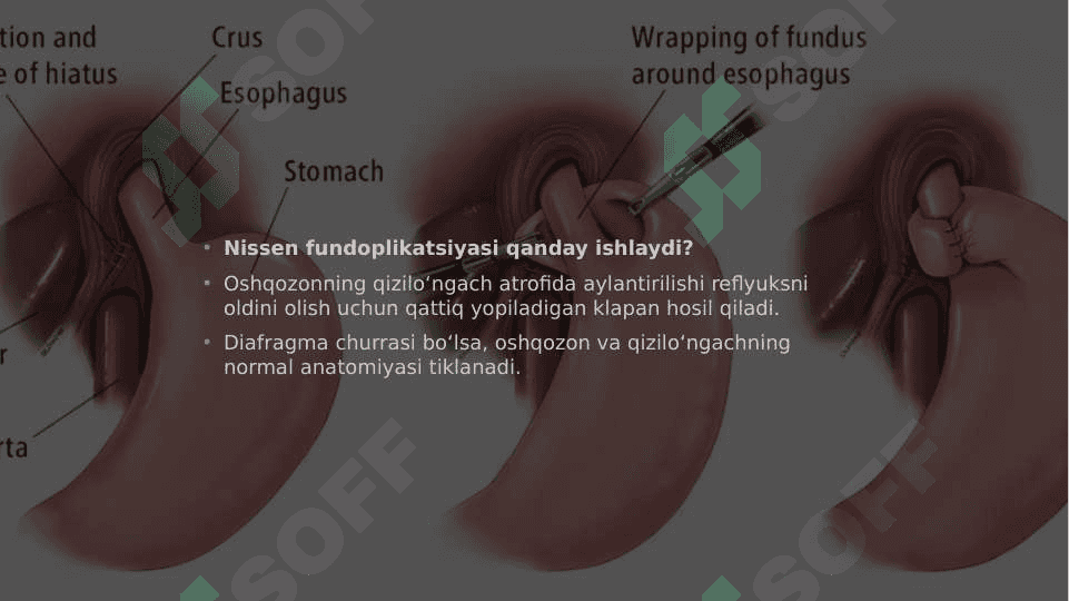 Diafragma churrasida nissen bo'yicha fundoplikatsiya amaliyoti 4