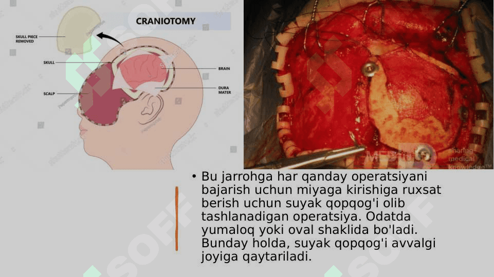 kraniotomiya 2