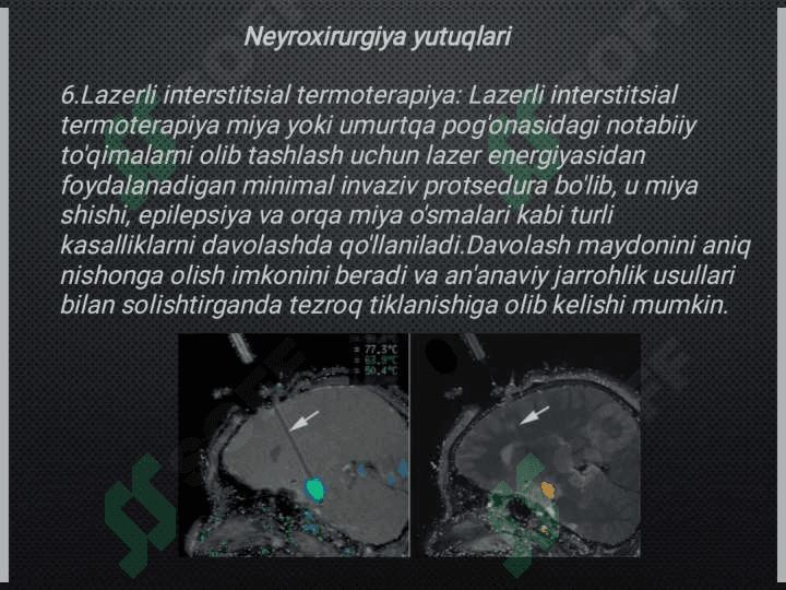 Neyroxirurgiyada qo'lga kiritilgan yutuqlar.Kraniotomiya va kranioplastika 6