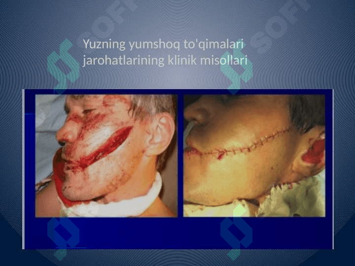 Yuz yumshoq to'qimalari jarohati 4