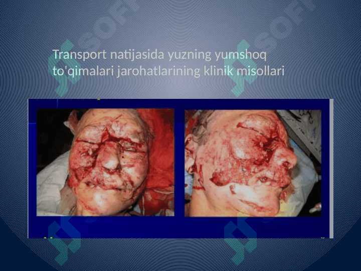 Yuz yumshoq to'qimalari jarohati 7