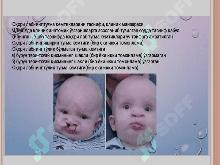 Yuqori lab va tanglay tug'ma kemtiklari 2