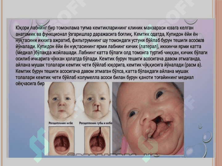 Yuqori lab va tanglay tug'ma kemtiklari 5