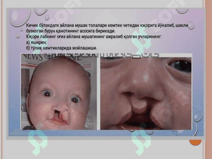 Yuqori lab va tanglay tug'ma kemtiklari 6
