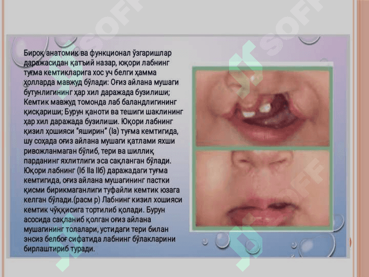 Yuqori lab va tanglay tug'ma kemtiklari 7