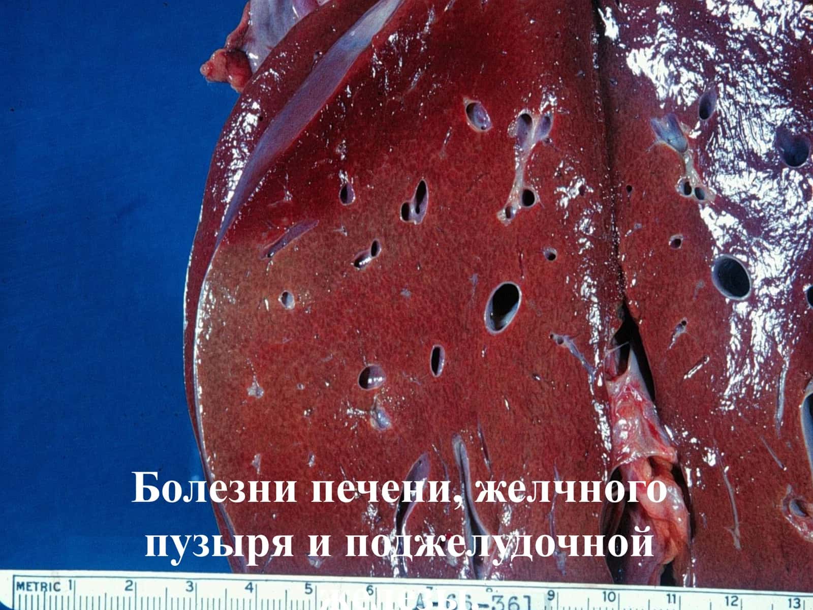 Болезни печени 1