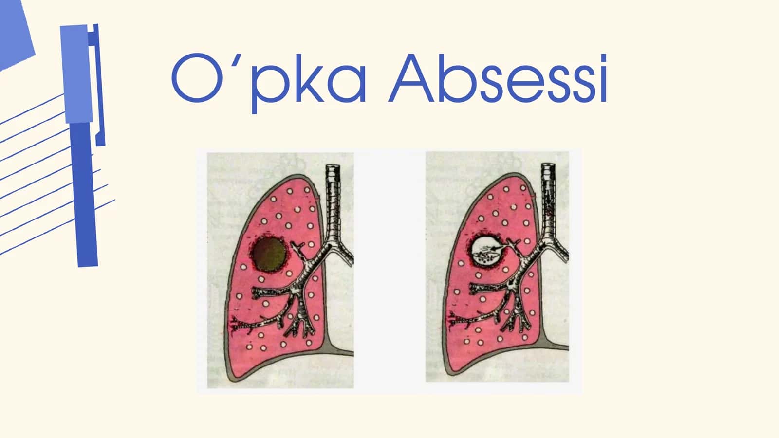 O'pka absessi 1