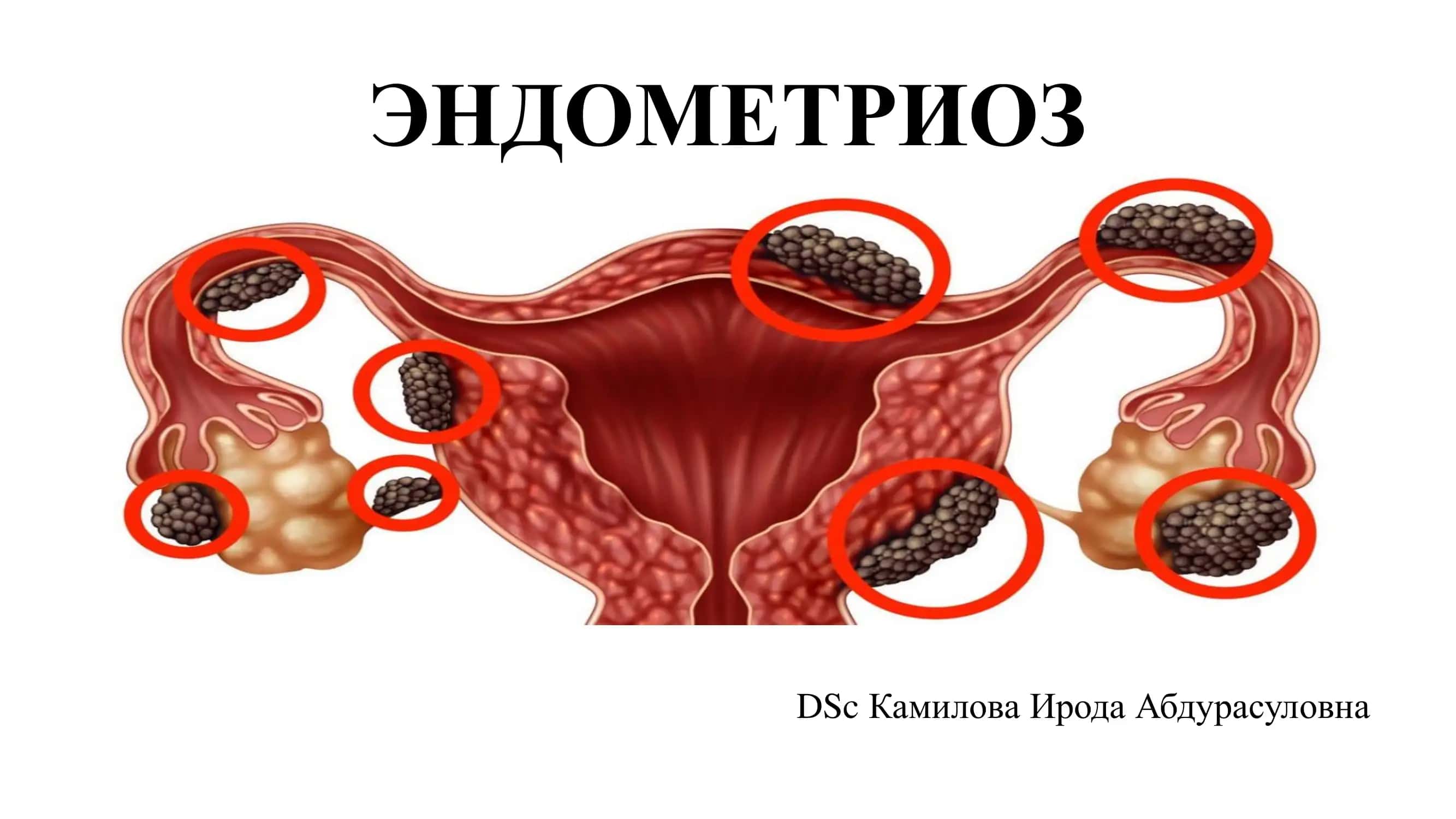 Endometrioz 1