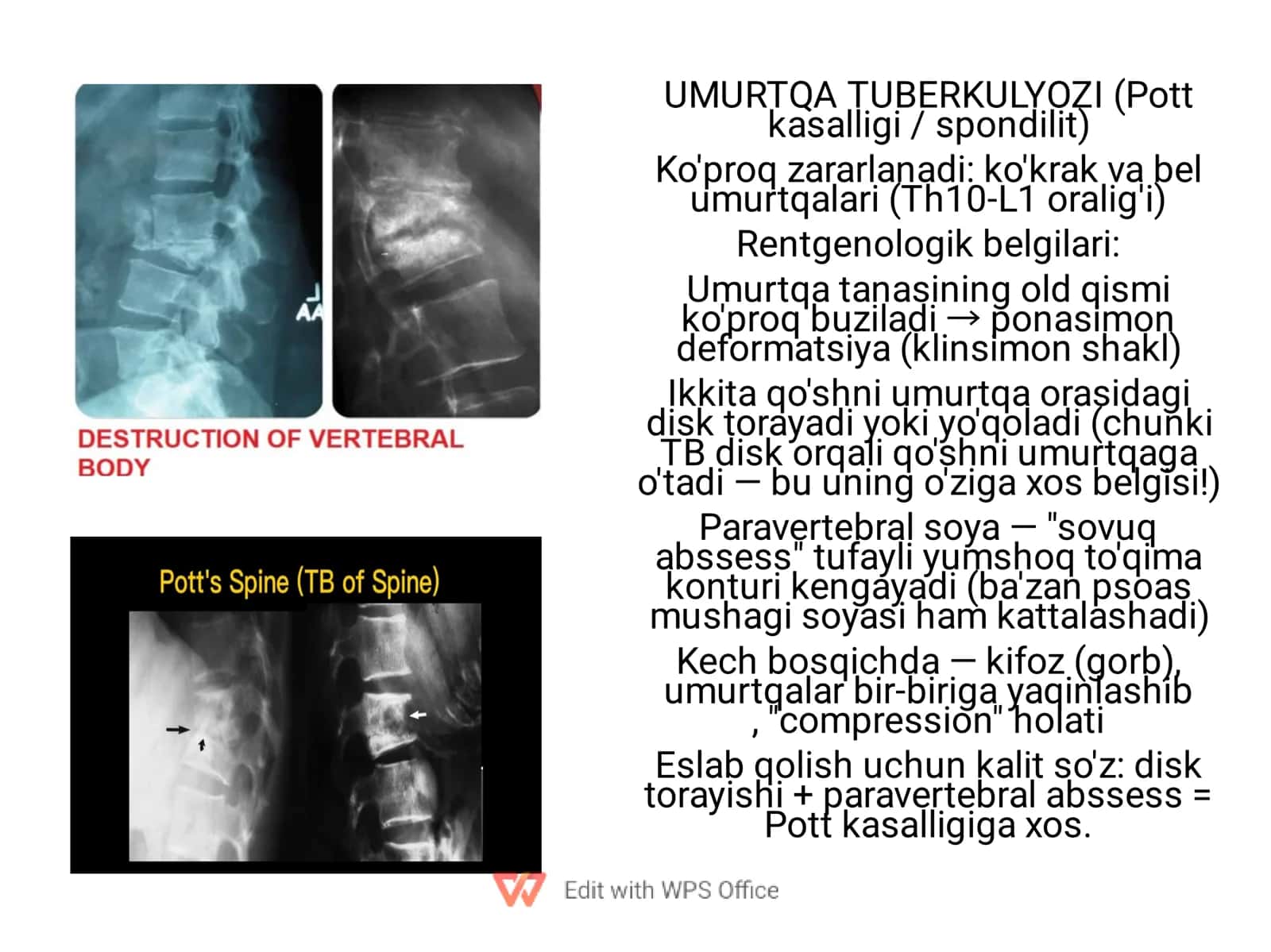 UMURTQA TUBERKULYOZI (Pott kasalligi / spondilit) 1