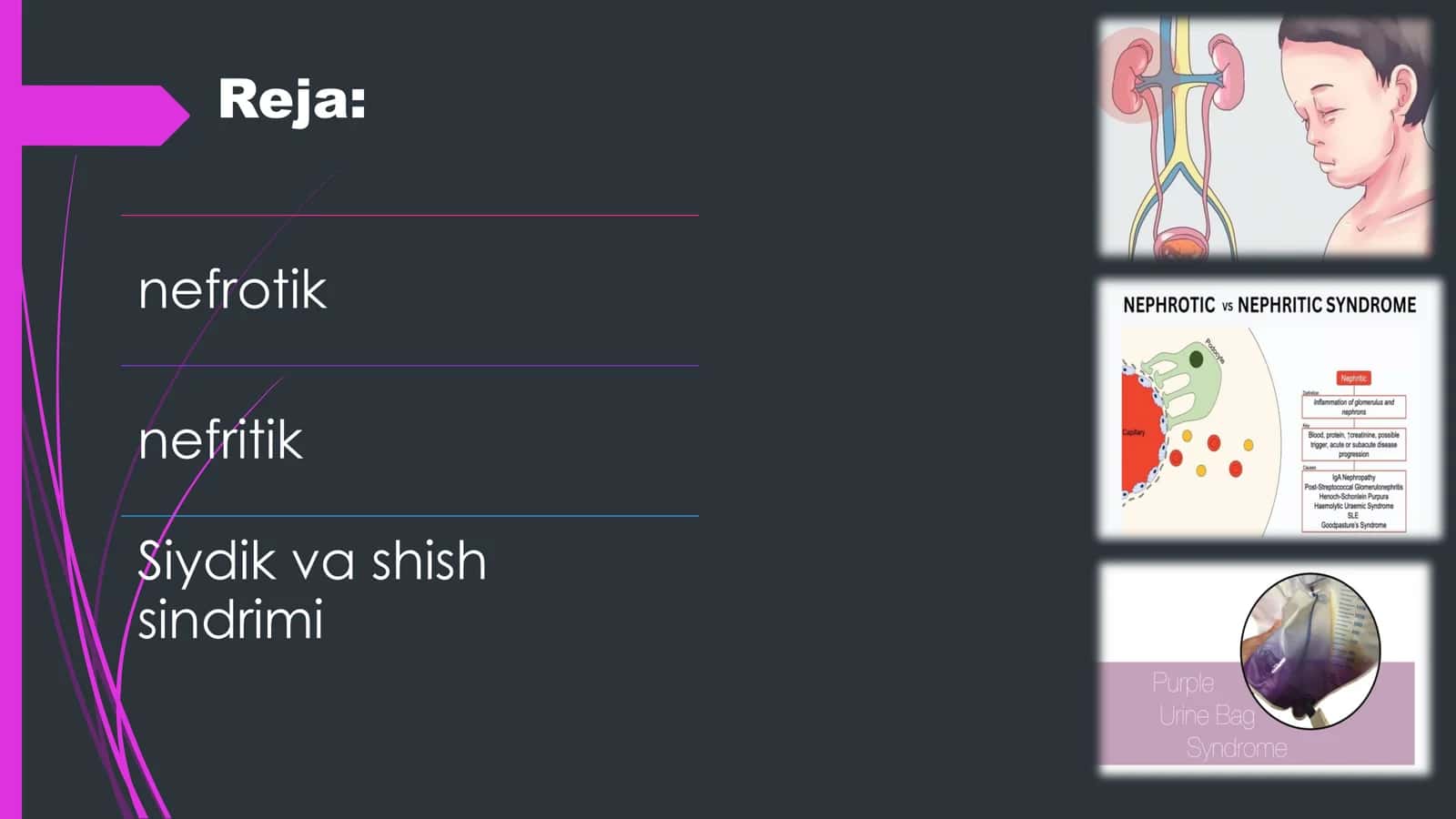 Siydik va Shish Sindromi 2