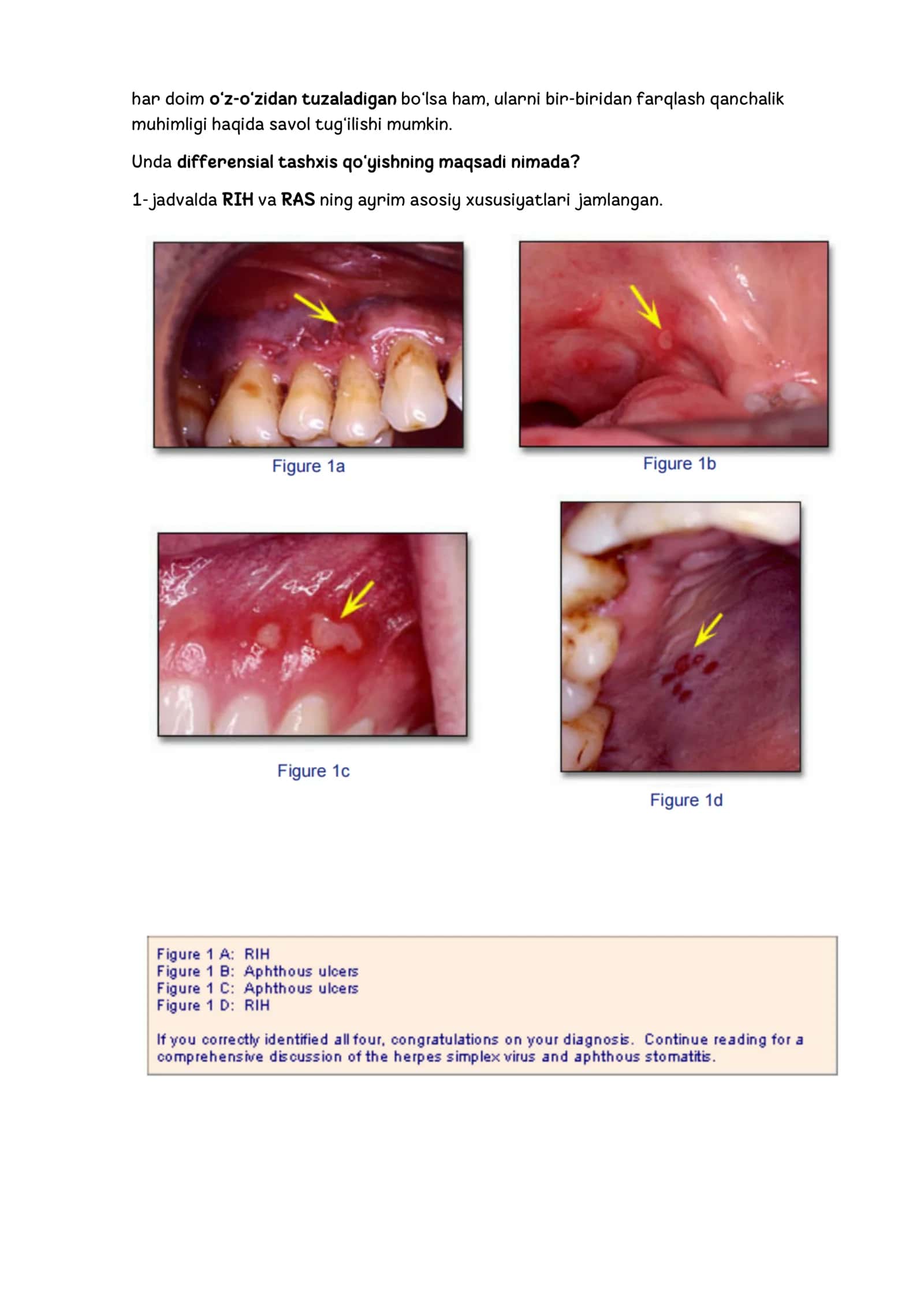 Recurrent aphthous stomatitis (RAS) va Recurrent intraoral herpes (RIH) ogʻiz bo‘shlig‘ida tez-tez uchraydigan kasalliklar 2