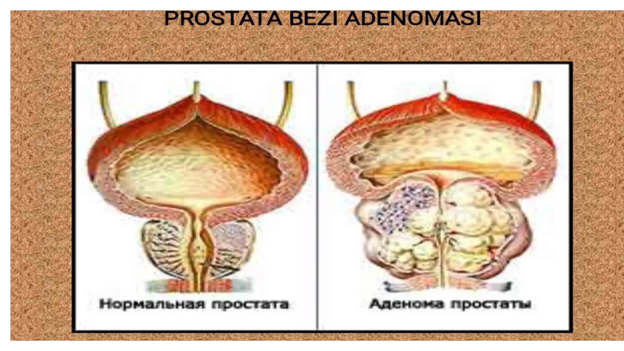 prostata bezi adenomasi 2