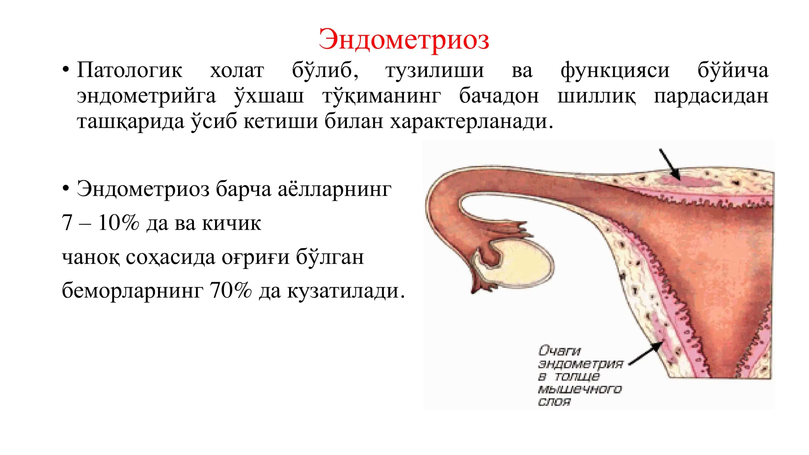 Endometrioz 2
