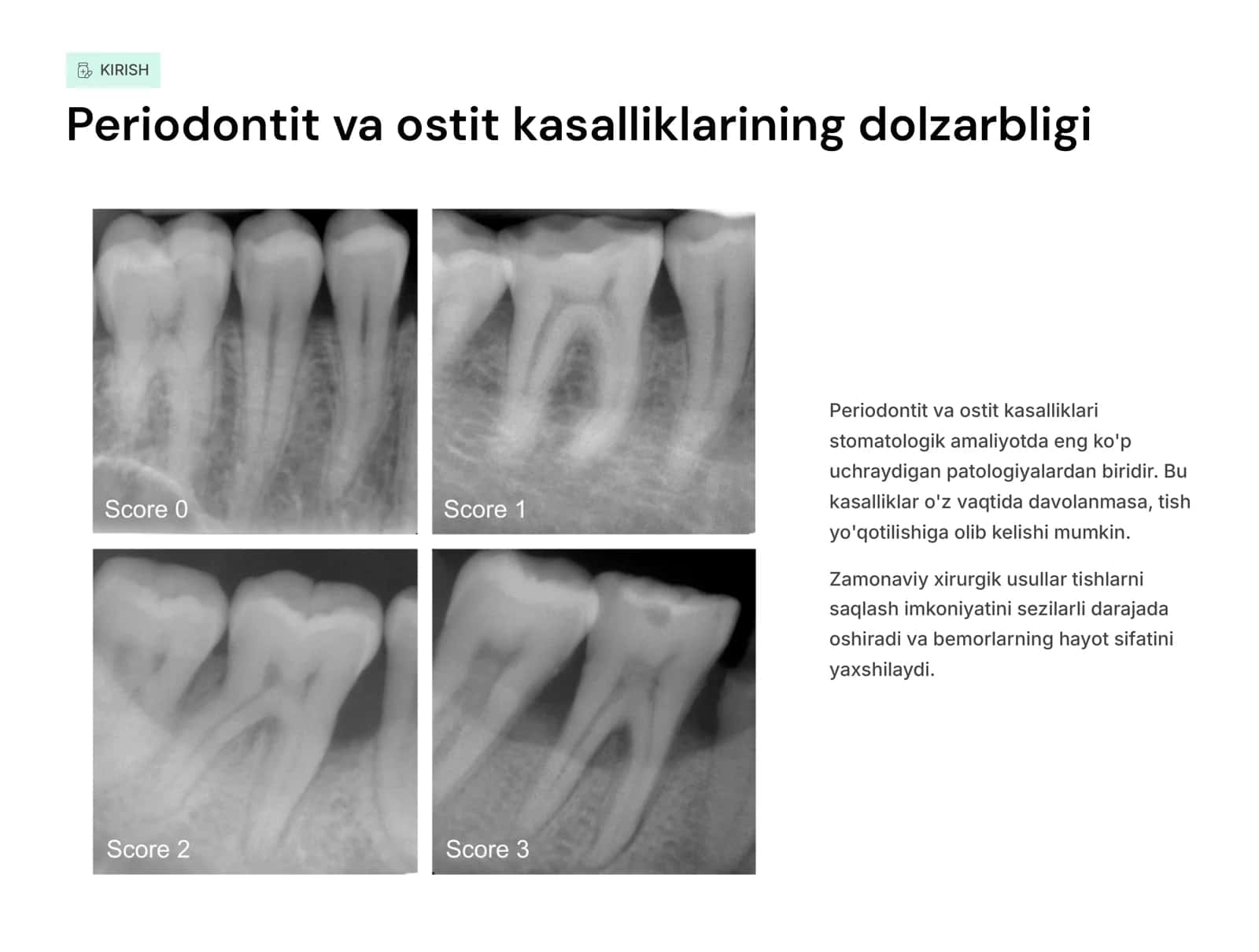 Periodontitlar va ostitlarni tashxislash natijalariga asoslangan holda xirurgik davolash usullariga ko’rsatma va qarshi ko’rsatmalar. Tish saqlovchi operatsiyalar (tish ildizi uchi rezeksiyasi, ildiz amputasiyasi, gemiseksiya, replantasiya) 2