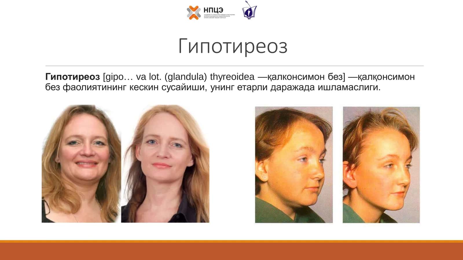 Гипотиреоз 2