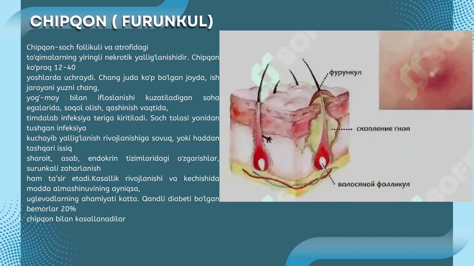 CHIPQON ( FURUNKUL) 2