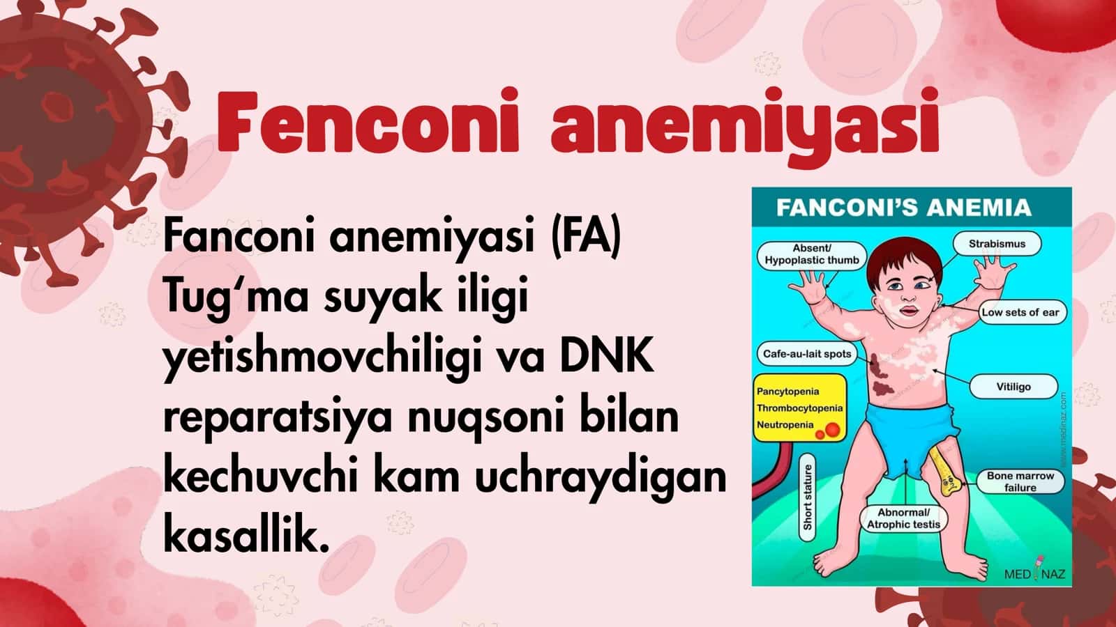 fenconi anemiyasi 2