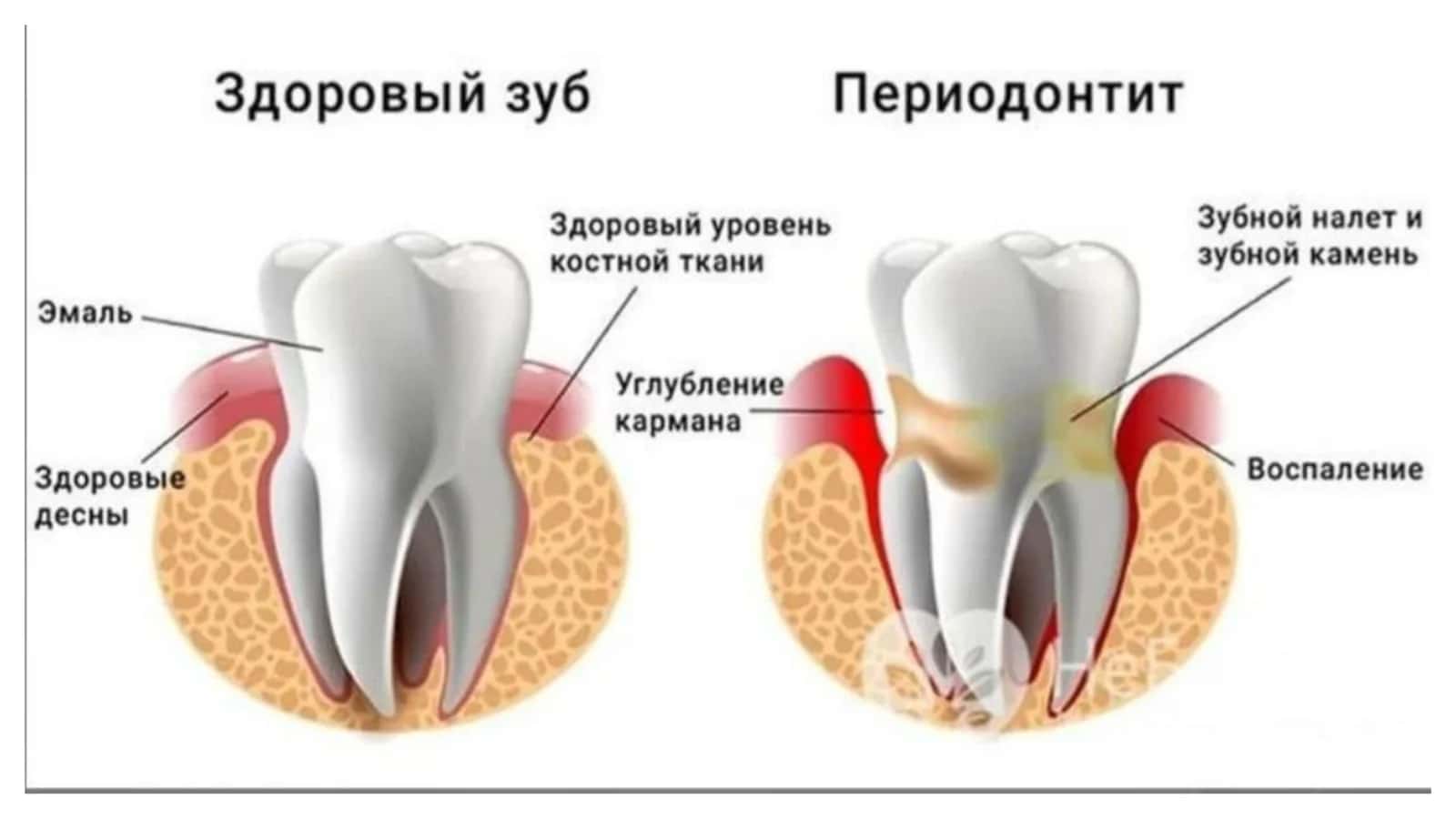 Otkir periodontitning  shakllarida birinchi yordam 2