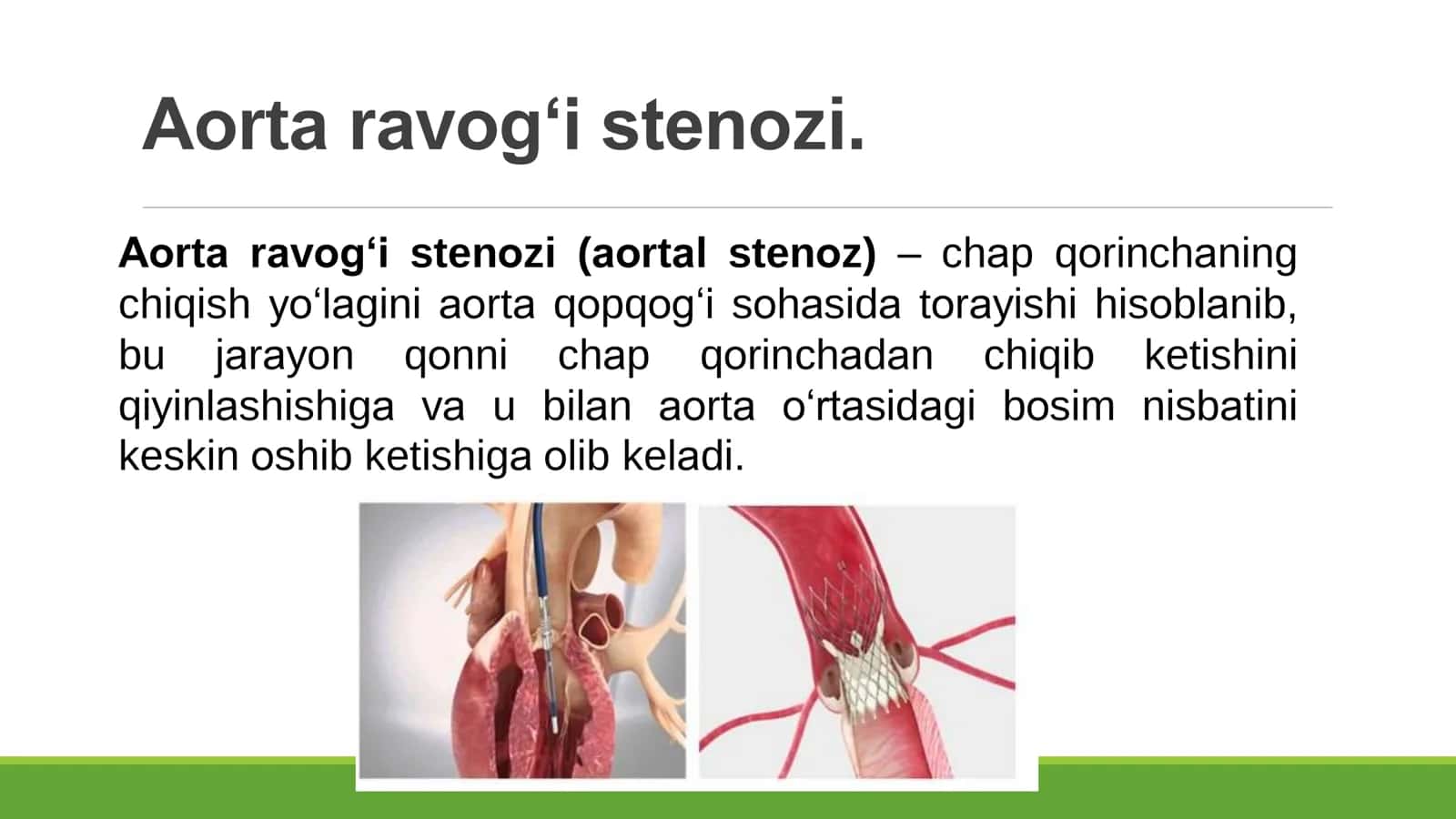 Aorta ravogi stenozi 2