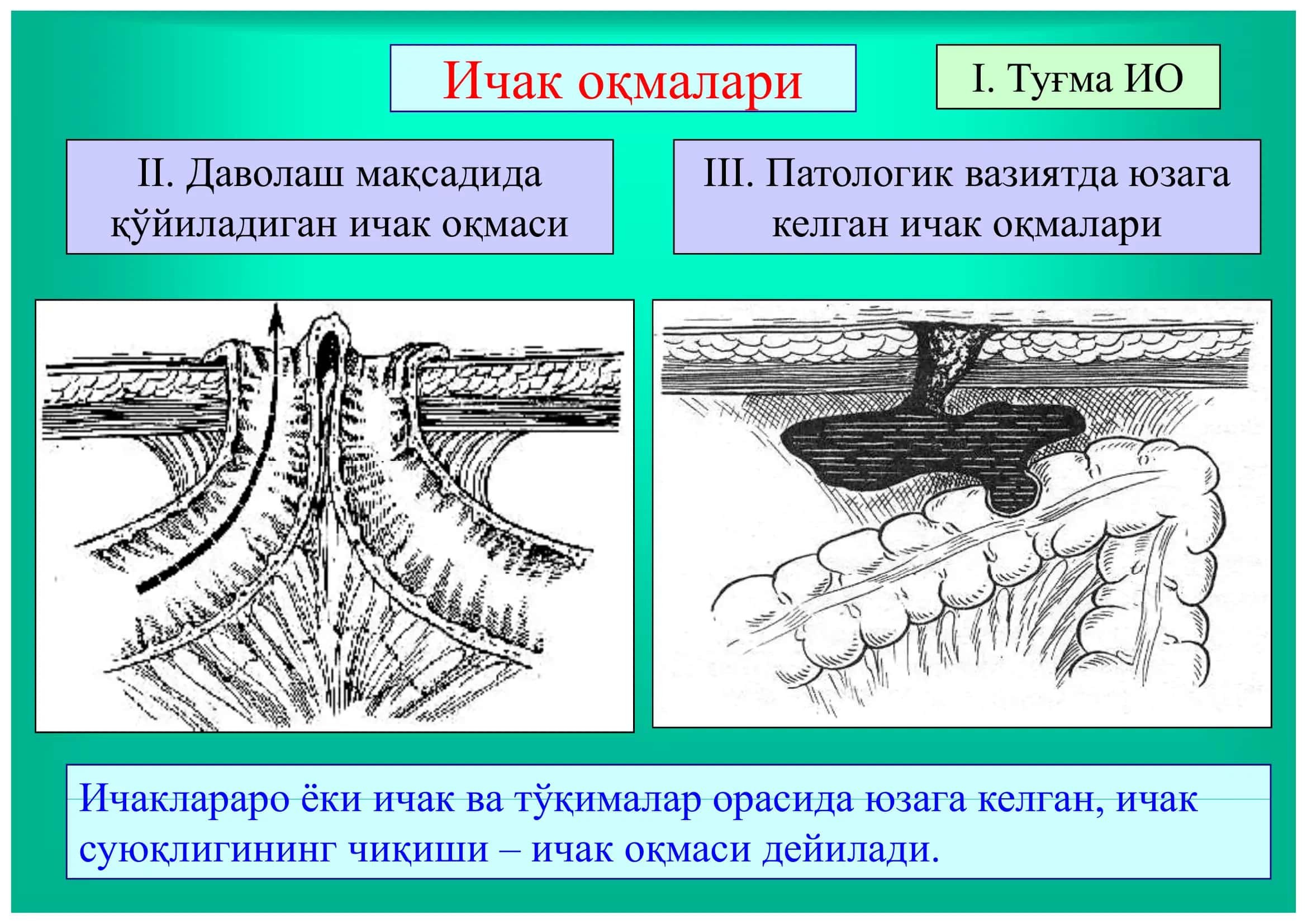 Ичак оқмалари 2