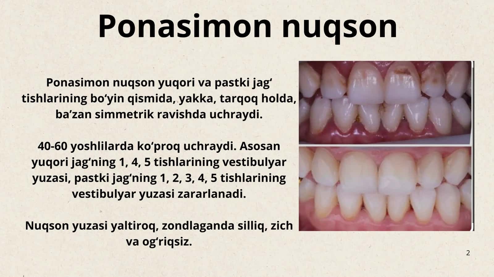 Tish chiqqandan keyin paydo bo‘ladigan nokaries kasalliklar. Ponasimon nuqson, nekroz va tish qattiq to‘qimasi eroziyasi. Klinikasi, tashxislash va qiyosiy tashxislash. 2